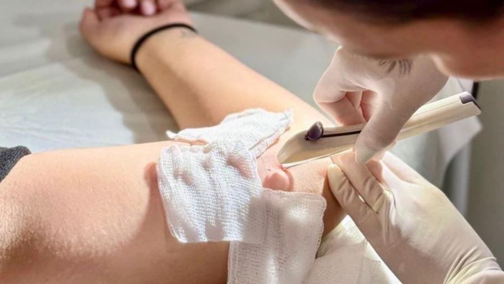 Profissional de saúde com luvas realiza procedimento de inserção de implante contraceptivo no braço de uma paciente